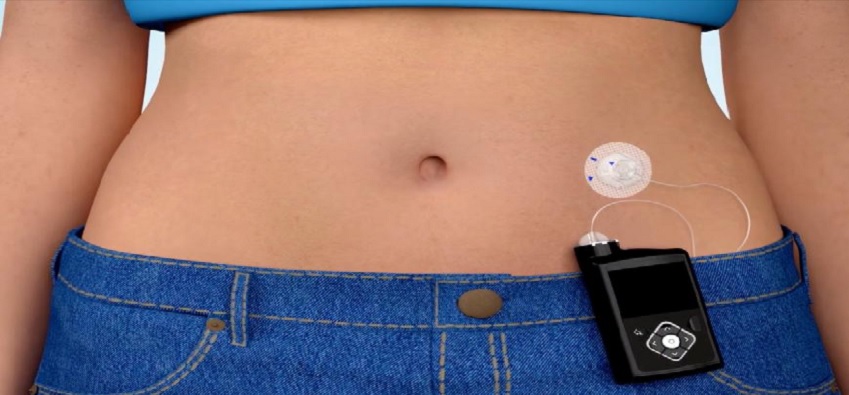 Insulin Pumps Market Grow Significantly